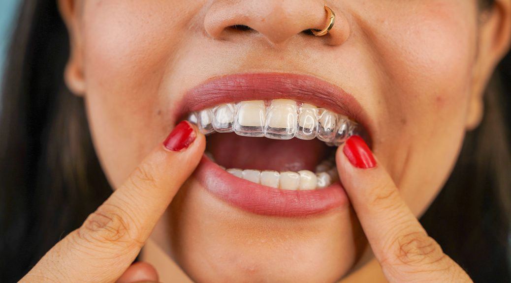 Perfecting Your Smile: The Art and Science Behind Invisalign