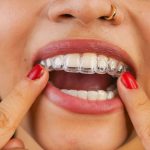 Perfecting Your Smile: The Art and Science Behind Invisalign