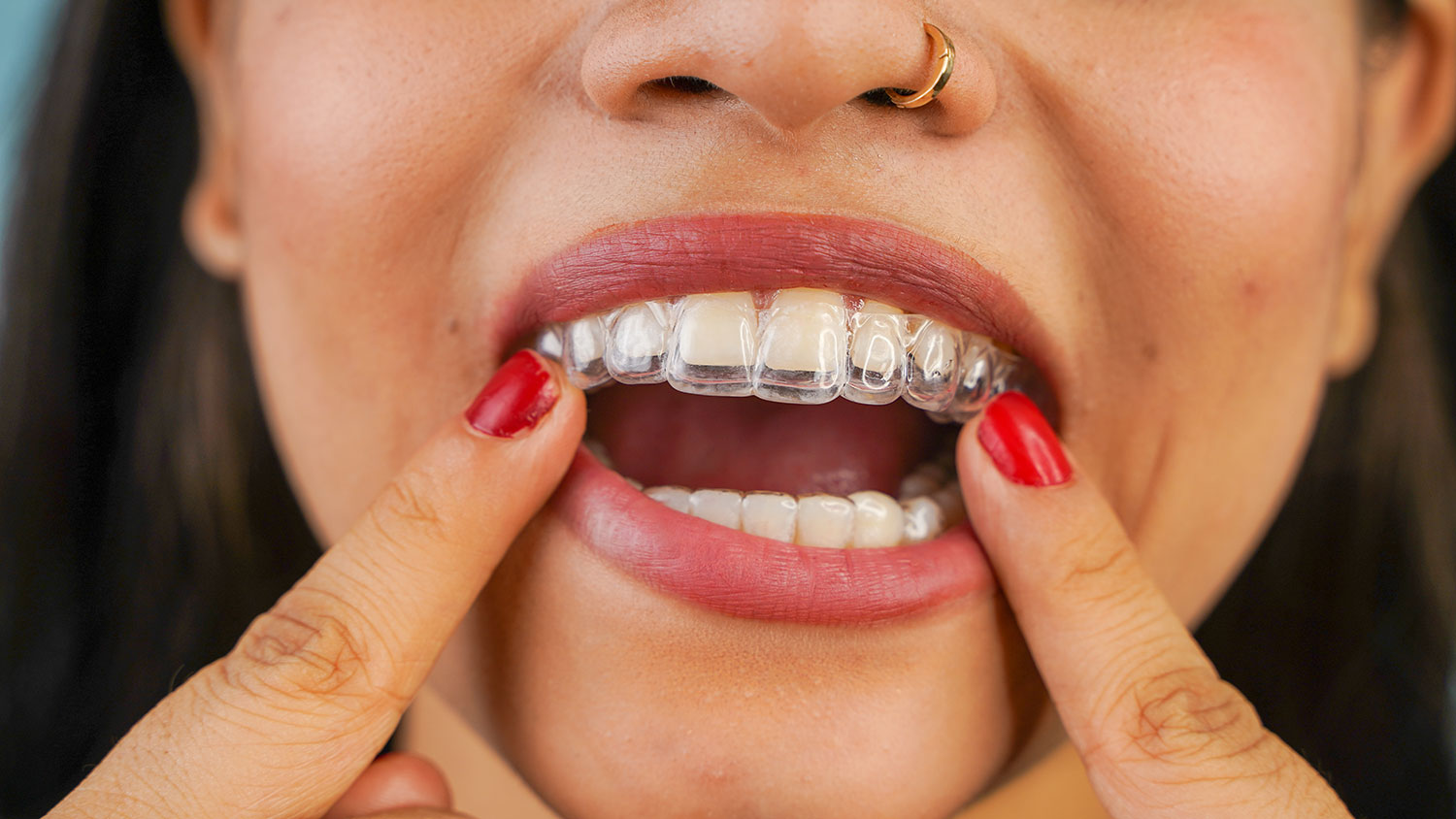 Perfecting Your Smile: The Art and Science Behind Invisalign